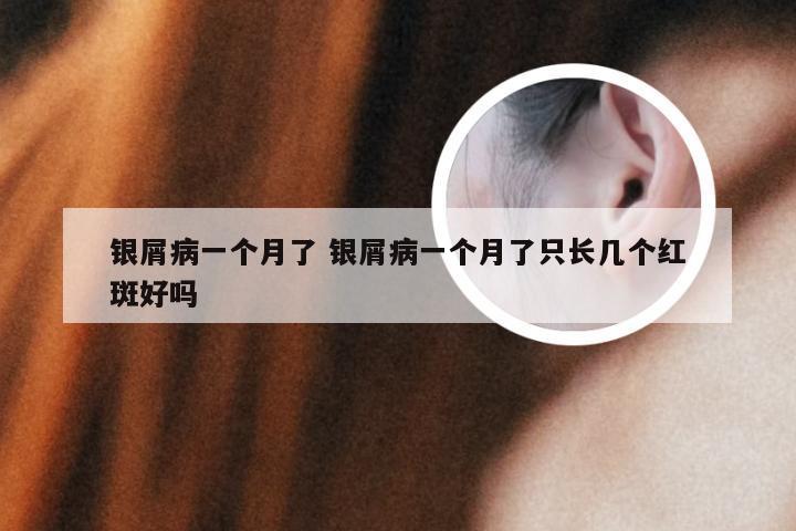 银屑病一个月了 银屑病一个月了只长几个红斑好吗