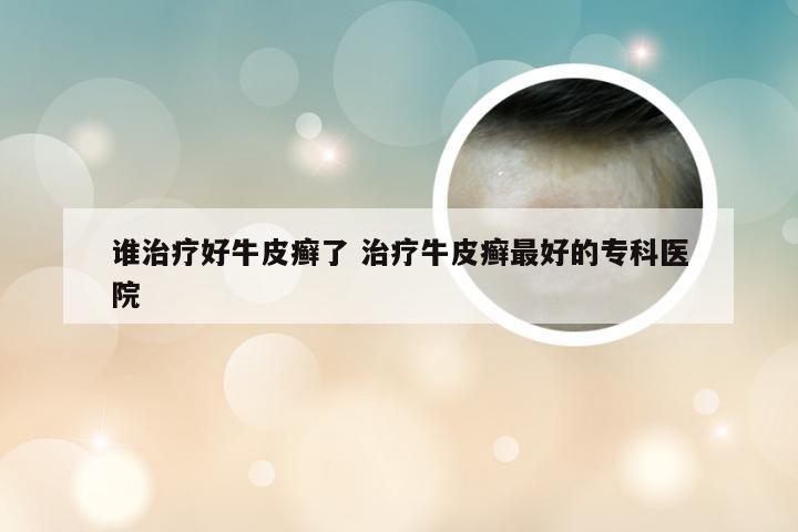 谁治疗好牛皮癣了 治疗牛皮癣最好的专科医院