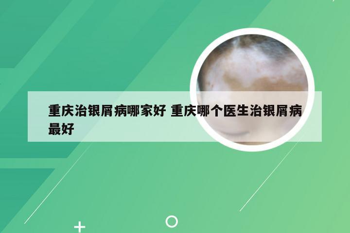 重庆治银屑病哪家好 重庆哪个医生治银屑病最好
