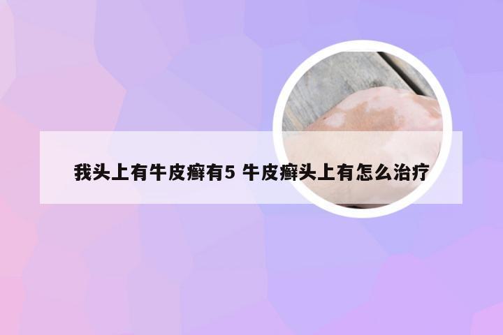 我头上有牛皮癣有5 牛皮癣头上有怎么治疗