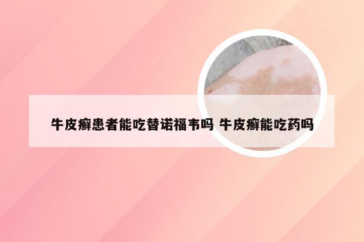 牛皮癣患者能吃替诺福韦吗 牛皮癣能吃药吗