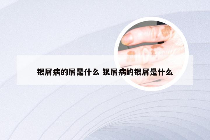 银屑病的屑是什么 银屑病的银屑是什么