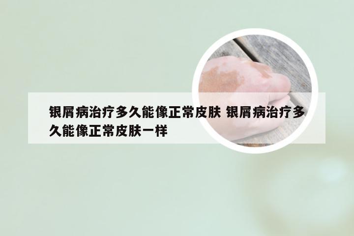 银屑病治疗多久能像正常皮肤 银屑病治疗多久能像正常皮肤一样