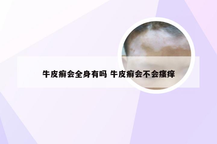 牛皮癣会全身有吗 牛皮癣会不会瘙痒