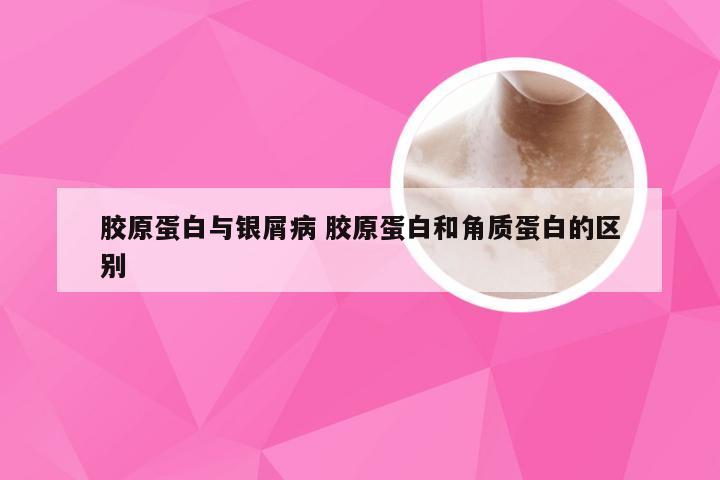 胶原蛋白与银屑病 胶原蛋白和角质蛋白的区别