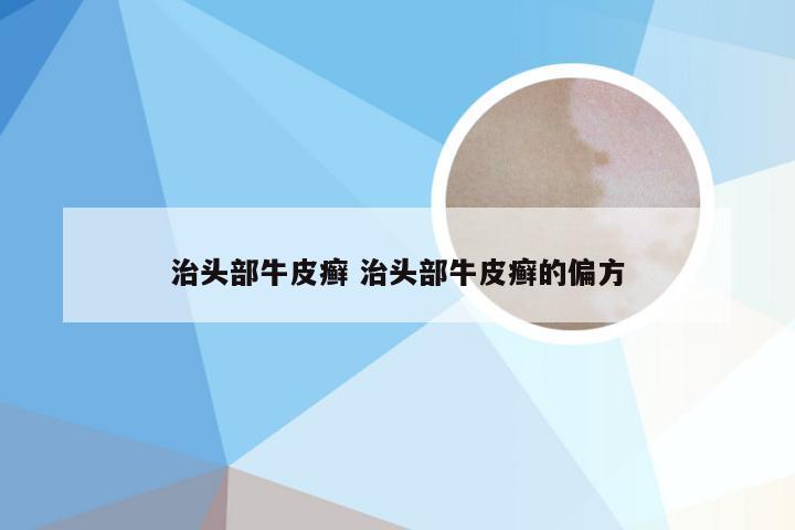 治头部牛皮癣 治头部牛皮癣的偏方