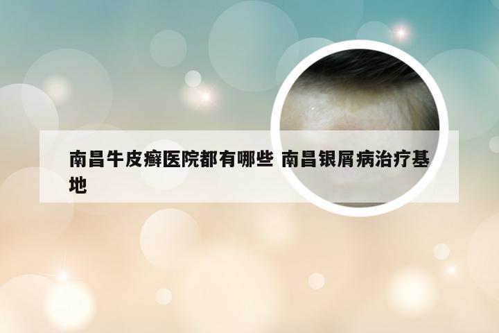 南昌牛皮癣医院都有哪些 南昌银屑病治疗基地