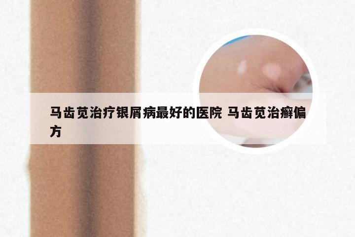 马齿苋治疗银屑病最好的医院 马齿苋治癣偏方
