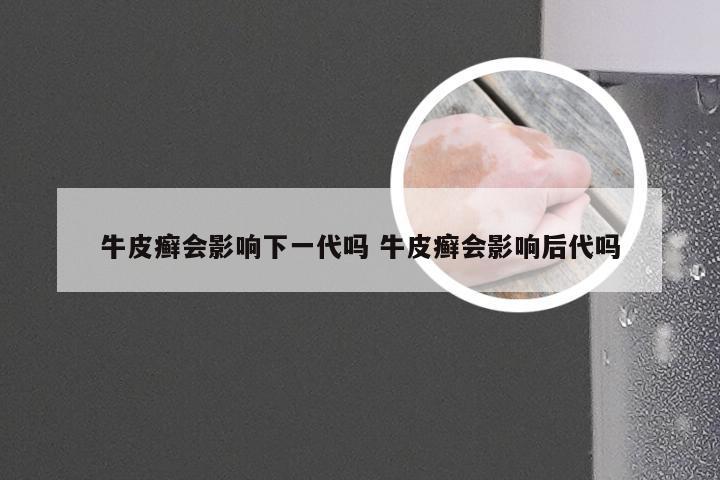 牛皮癣会影响下一代吗 牛皮癣会影响后代吗