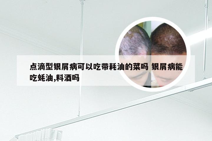 点滴型银屑病可以吃带耗油的菜吗 银屑病能吃蚝油,料酒吗