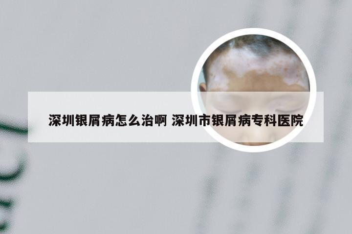 深圳银屑病怎么治啊 深圳市银屑病专科医院