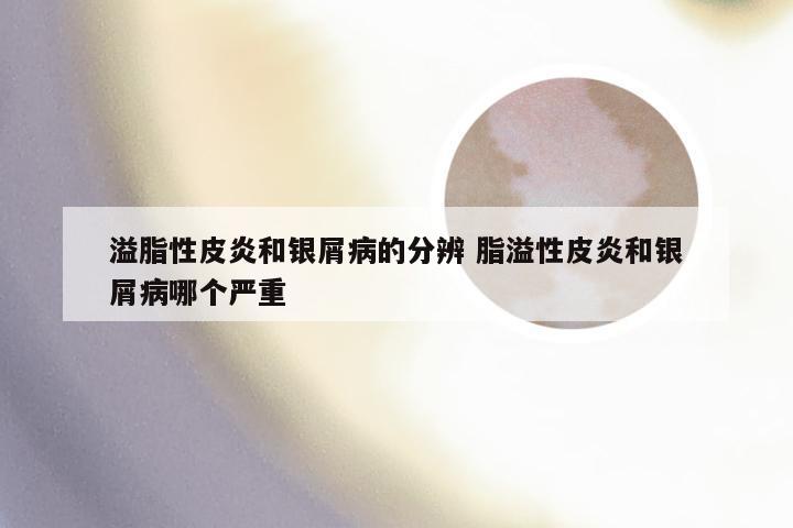 溢脂性皮炎和银屑病的分辨 脂溢性皮炎和银屑病哪个严重