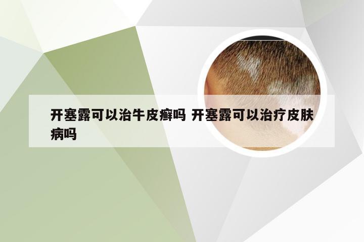 开塞露可以治牛皮癣吗 开塞露可以治疗皮肤病吗