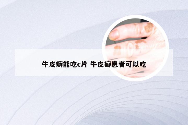 牛皮癣能吃c片 牛皮癣患者可以吃