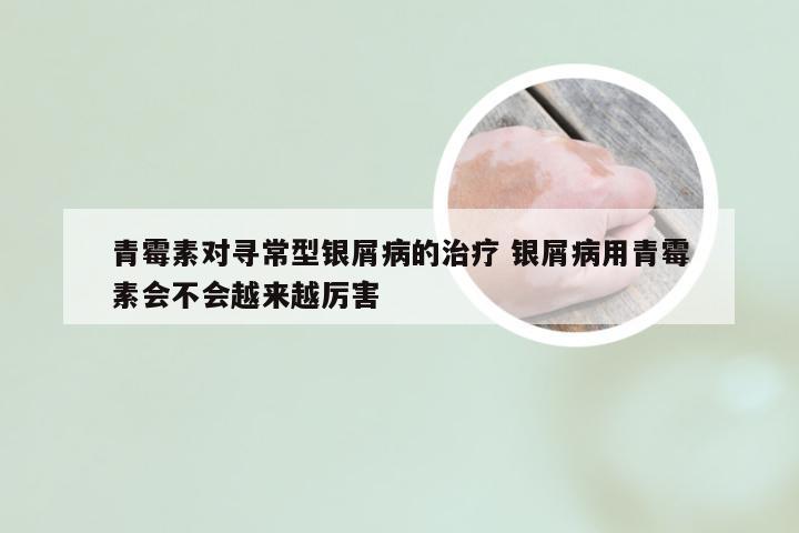 青霉素对寻常型银屑病的治疗 银屑病用青霉素会不会越来越厉害