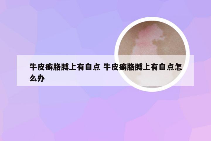牛皮癣胳膊上有白点 牛皮癣胳膊上有白点怎么办