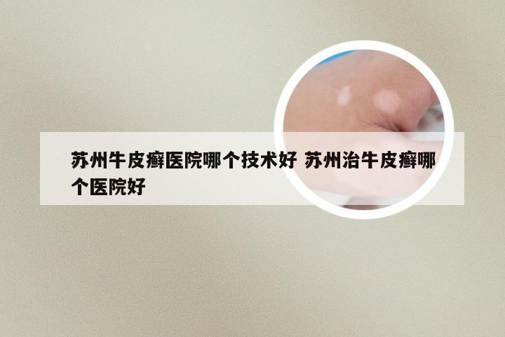 苏州牛皮癣医院哪个技术好 苏州治牛皮癣哪个医院好