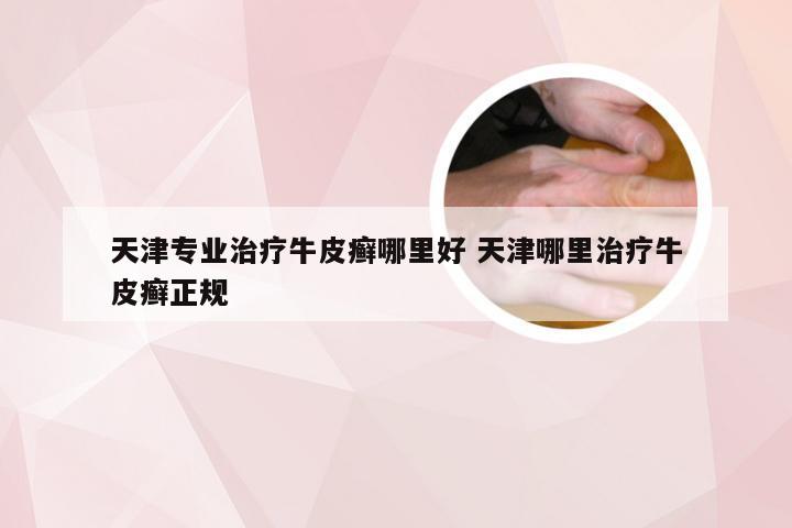 天津专业治疗牛皮癣哪里好 天津哪里治疗牛皮癣正规