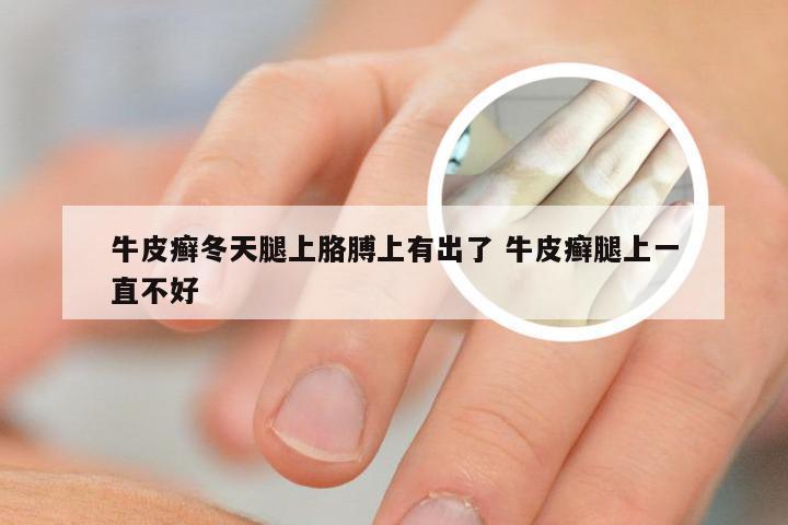 牛皮癣冬天腿上胳膊上有出了 牛皮癣腿上一直不好