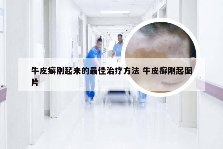 牛皮癣刚起来的最佳治疗方法 牛皮癣刚起图片