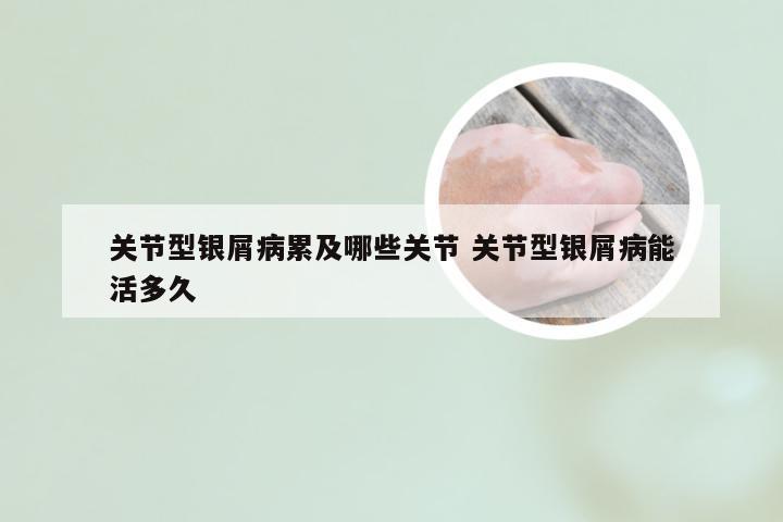 关节型银屑病累及哪些关节 关节型银屑病能活多久