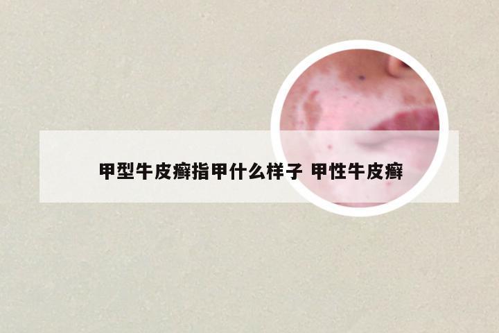 甲型牛皮癣指甲什么样子 甲性牛皮癣