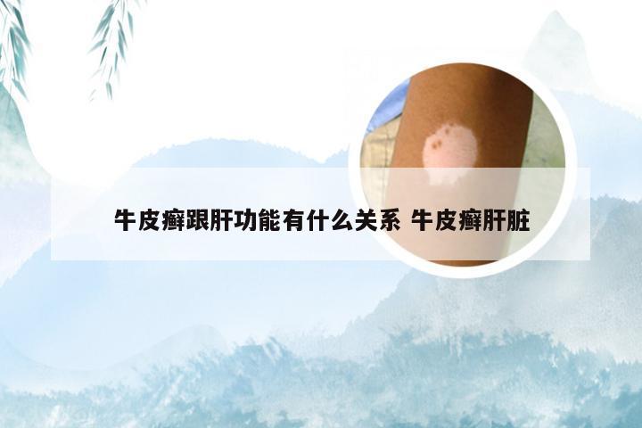 牛皮癣跟肝功能有什么关系 牛皮癣肝脏