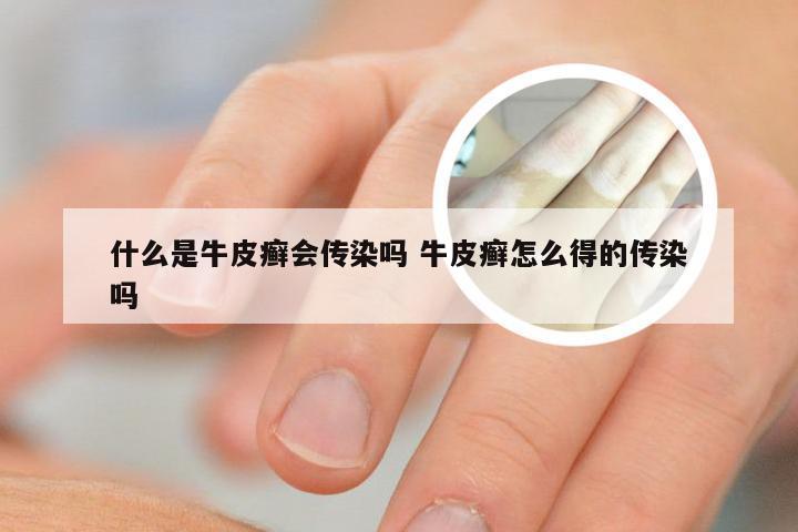 什么是牛皮癣会传染吗 牛皮癣怎么得的传染吗