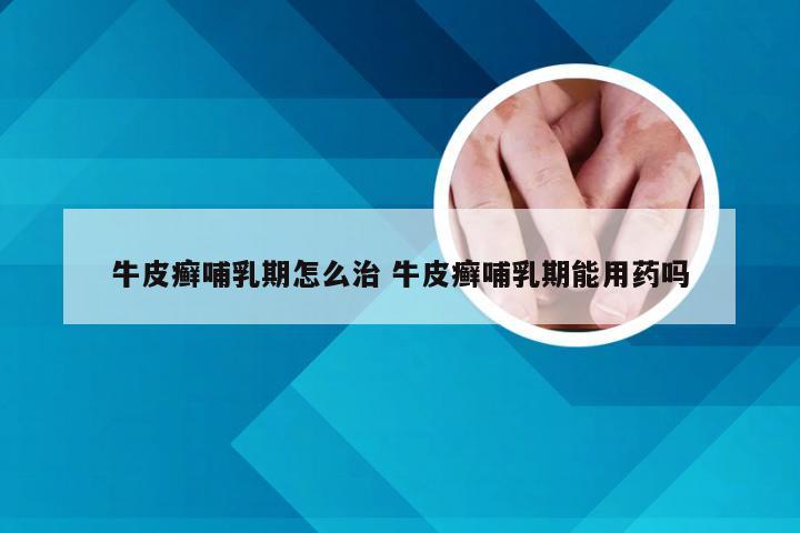 牛皮癣哺乳期怎么治 牛皮癣哺乳期能用药吗