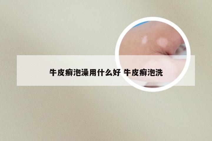 牛皮癣泡澡用什么好 牛皮癣泡洗