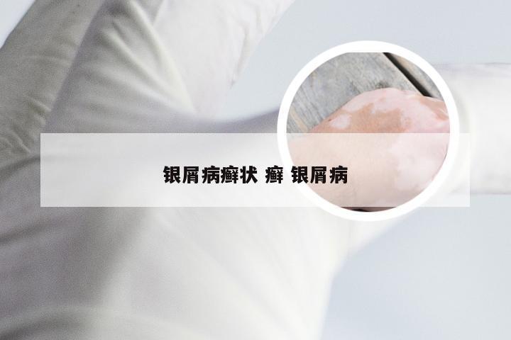 银屑病癣状 癣 银屑病
