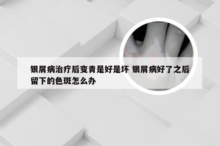银屑病治疗后变青是好是坏 银屑病好了之后留下的色斑怎么办