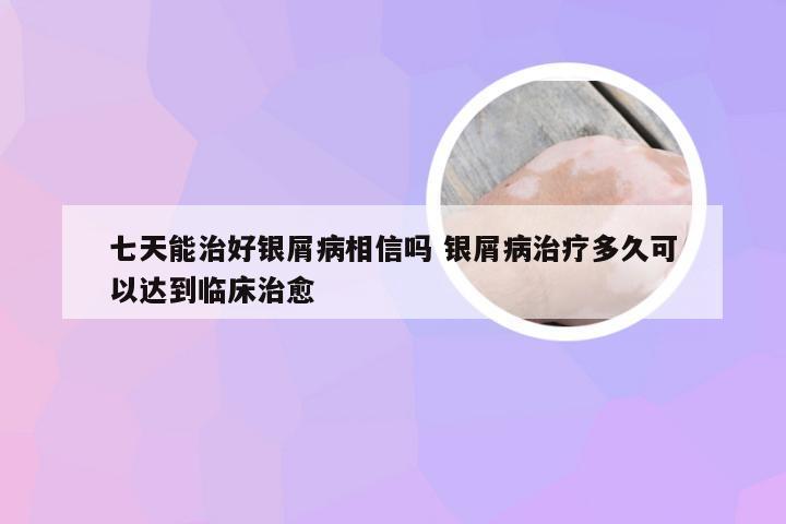 七天能治好银屑病相信吗 银屑病治疗多久可以达到临床治愈