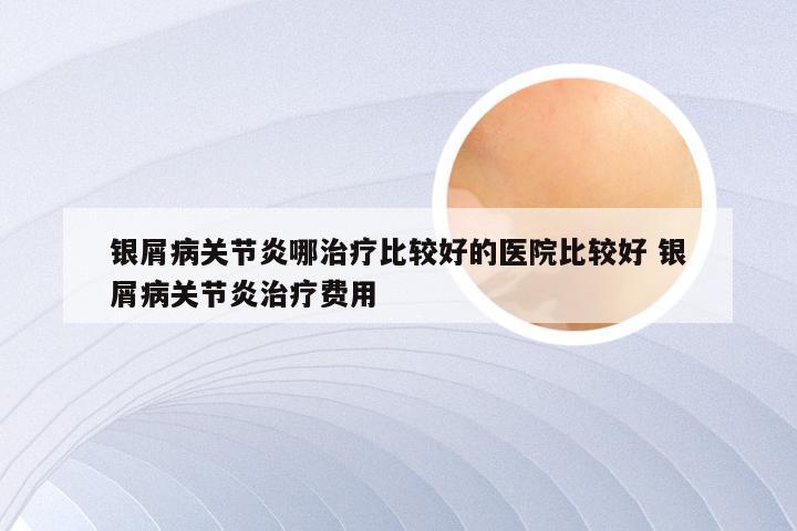 银屑病关节炎哪治疗比较好的医院比较好 银屑病关节炎治疗费用