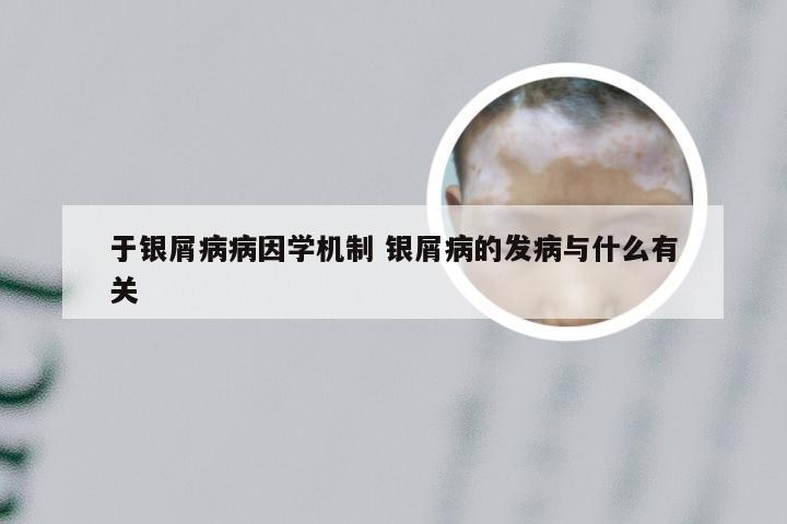 于银屑病病因学机制 银屑病的发病与什么有关