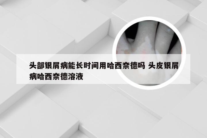 头部银屑病能长时间用哈西奈德吗 头皮银屑病哈西奈德溶液