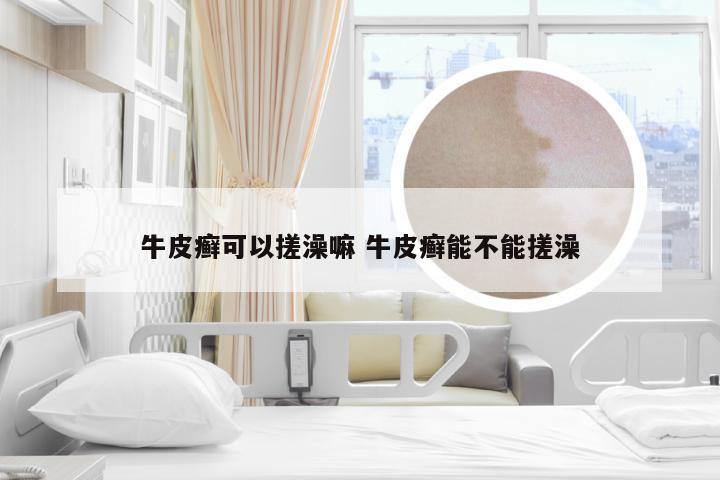 牛皮癣可以搓澡嘛 牛皮癣能不能搓澡
