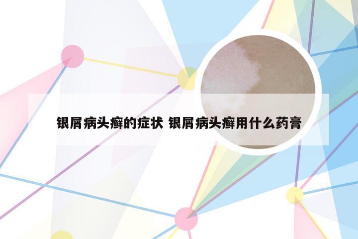 银屑病头癣的症状 银屑病头癣用什么药膏
