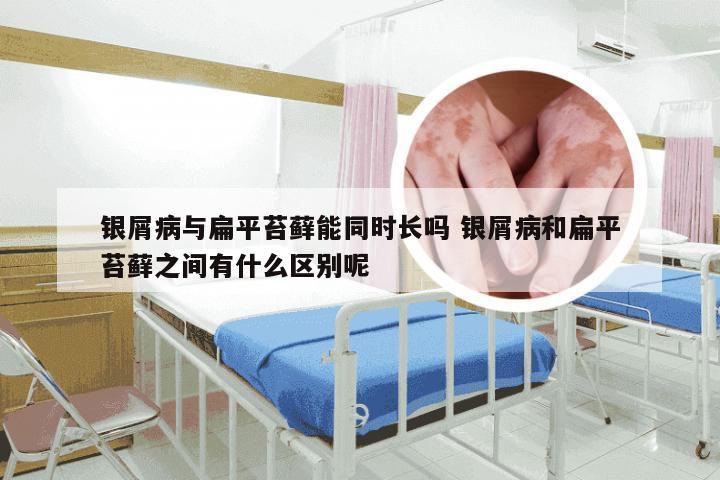 银屑病与扁平苔藓能同时长吗 银屑病和扁平苔藓之间有什么区别呢