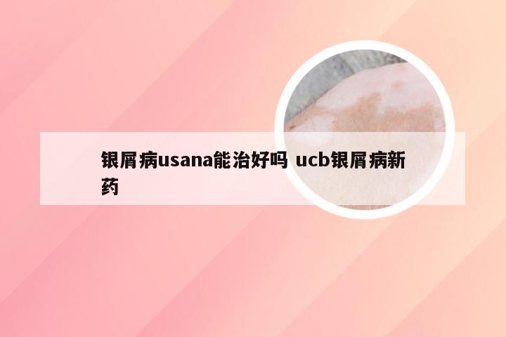 银屑病usana能治好吗 ucb银屑病新药