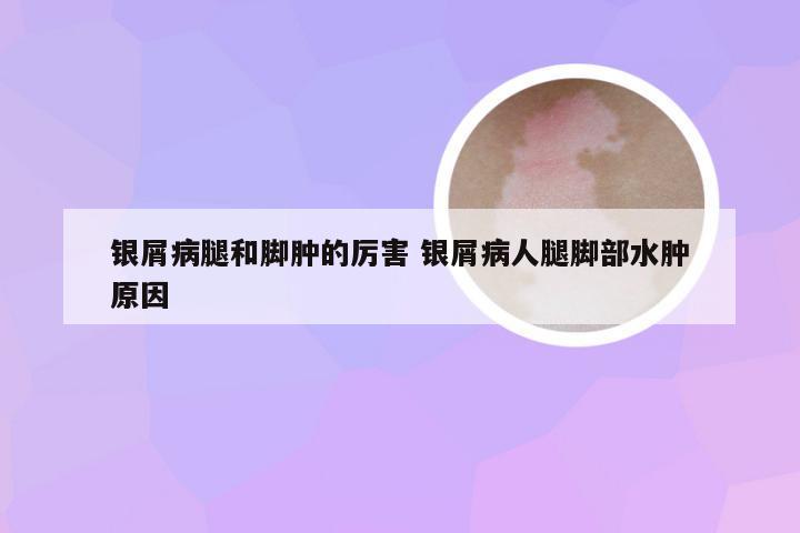 银屑病腿和脚肿的厉害 银屑病人腿脚部水肿原因