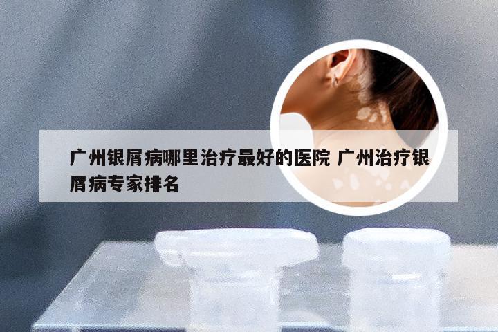 广州银屑病哪里治疗最好的医院 广州治疗银屑病专家排名