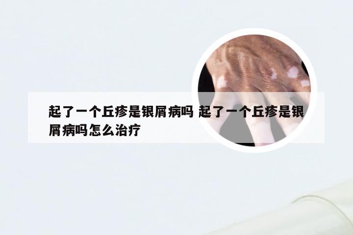起了一个丘疹是银屑病吗 起了一个丘疹是银屑病吗怎么治疗