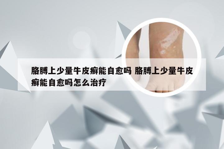 胳膊上少量牛皮癣能自愈吗 胳膊上少量牛皮癣能自愈吗怎么治疗