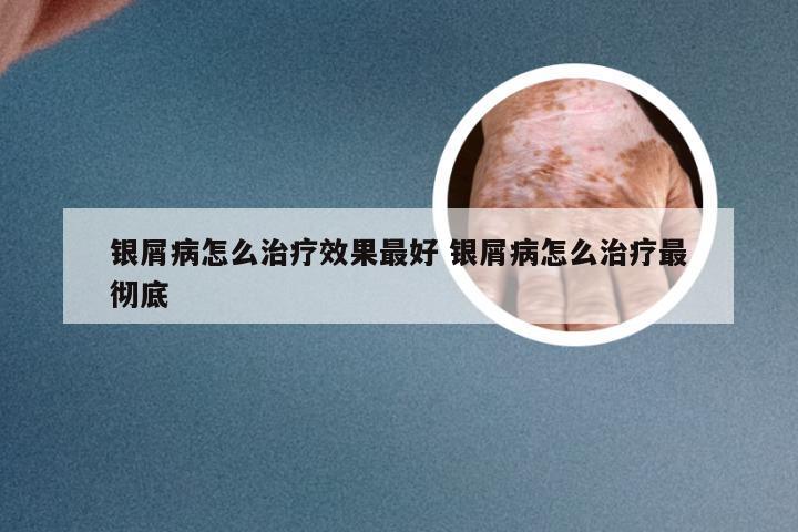 银屑病怎么治疗效果最好 银屑病怎么治疗最彻底