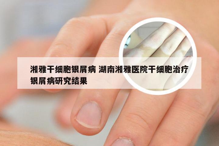湘雅干细胞银屑病 湖南湘雅医院干细胞治疗银屑病研究结果