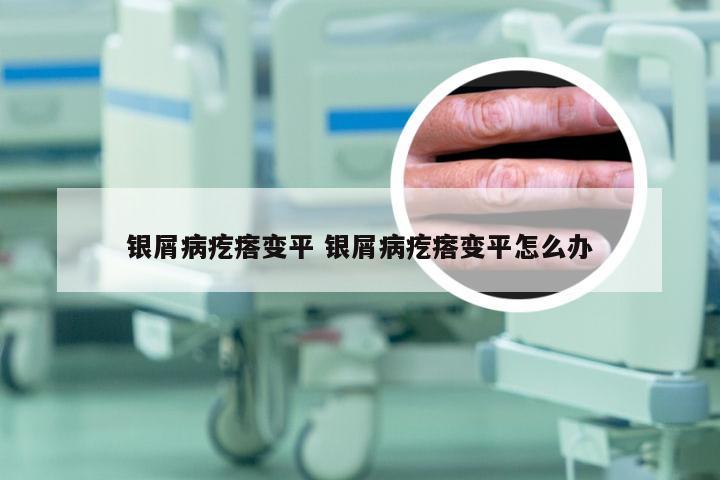 银屑病疙瘩变平 银屑病疙瘩变平怎么办