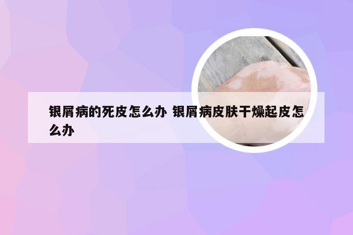 银屑病的死皮怎么办 银屑病皮肤干燥起皮怎么办
