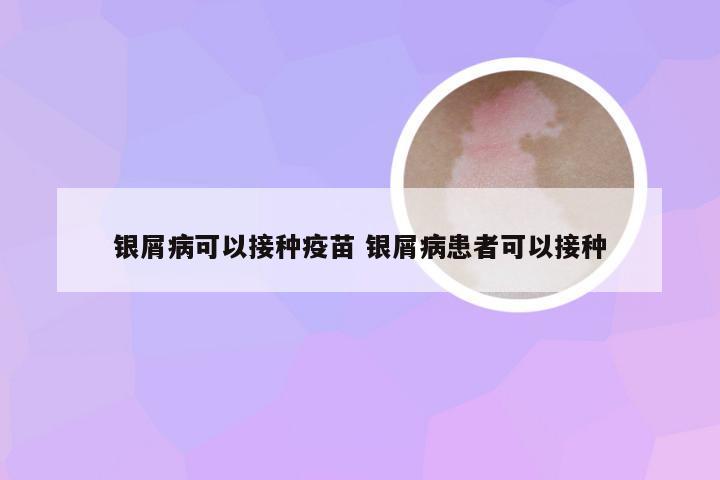 银屑病可以接种疫苗 银屑病患者可以接种