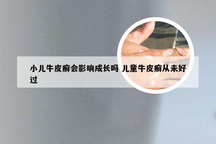 小儿牛皮癣会影响成长吗 儿童牛皮癣从未好过